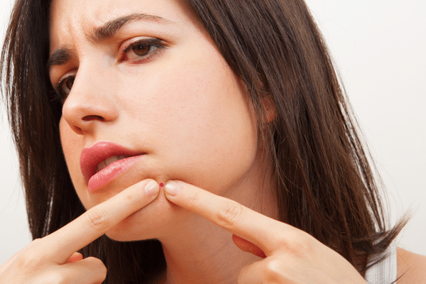 How can I get rid of pimples?