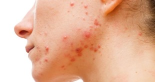 What causes cystic acne