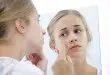 mild acne scars